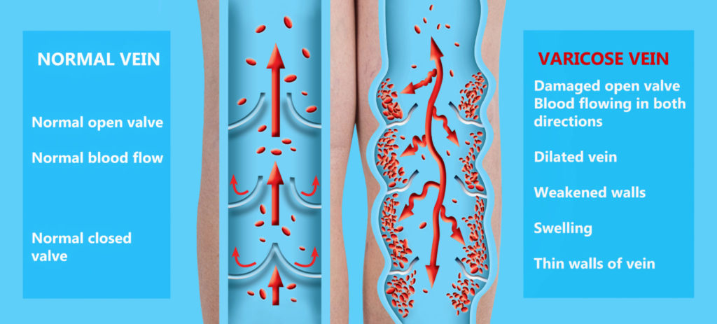 normal vein vs. varicose vein diagram by Maryland Vascular Specialists