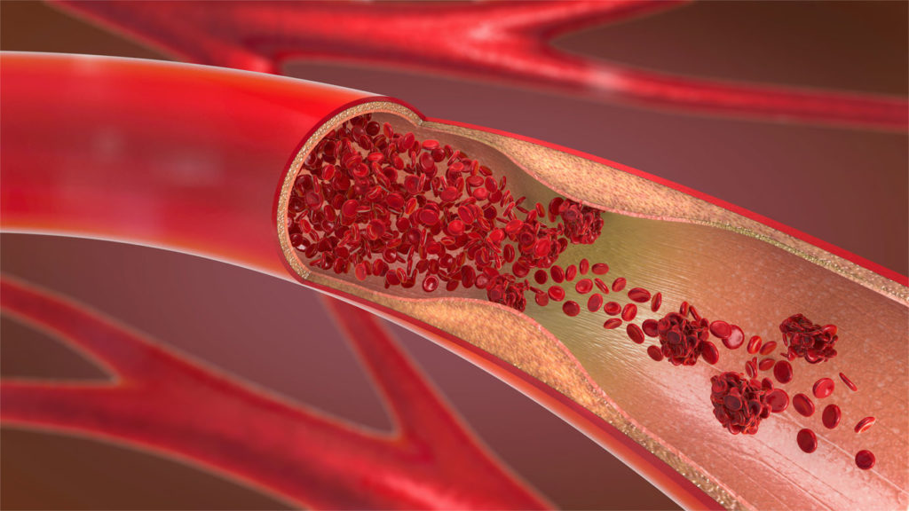 deep vein thrombosis diagram - Maryland Vascular Specialists